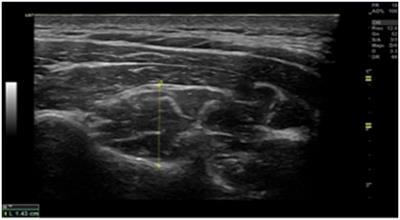 Cervical impairments in subjects with migraine or tension type headache: an observational study